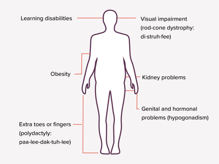 The signs and symptoms of Bardet-Biedl syndrome (BBS) diagram